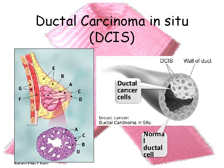 Ductal Carcinoma in situ (DCIS) Ductal cancer cells 16 Illustration © Mary K. Bryson
