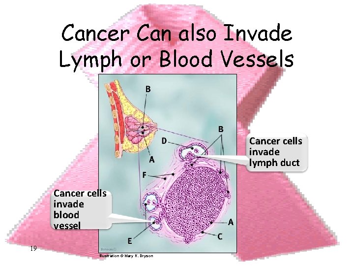 Cancer Can also Invade Lymph or Blood Vessels Cancer cells invade lymph duct Cancer