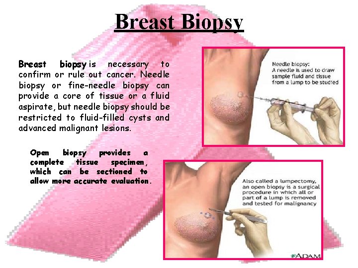 Breast Biopsy Breast biopsy is necessary to confirm or rule out cancer. Needle biopsy