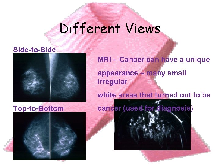 Different Views Side-to-Side MRI - Cancer can have a unique appearance – many small