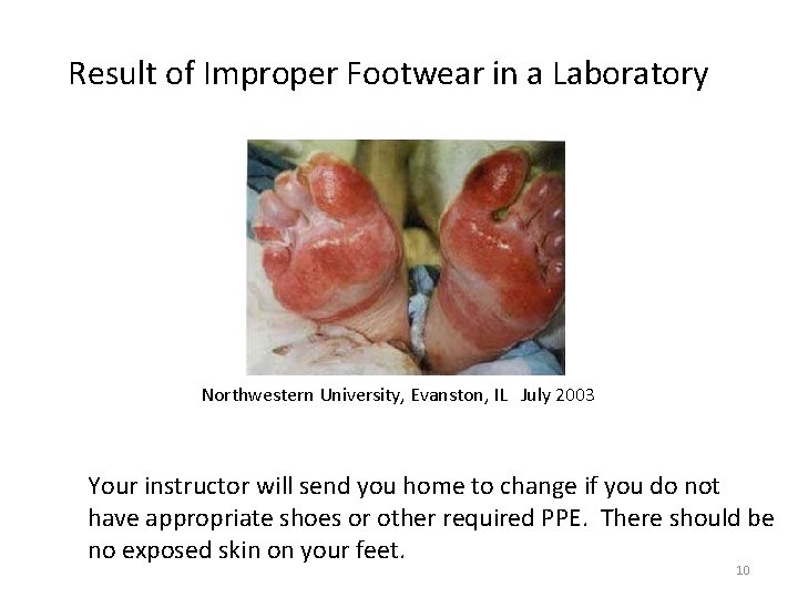 Result of Improper Footwear in a Laboratory Northwestern University, Evanston, IL July 2003 Your