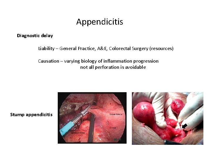 Appendicitis Diagnostic delay Liability – General Practice, A&E, Colorectal Surgery (resources) Causation – varying Appendicitis Diagnostic delay Liability – General Practice, A&E, Colorectal Surgery (resources) Causation – varying