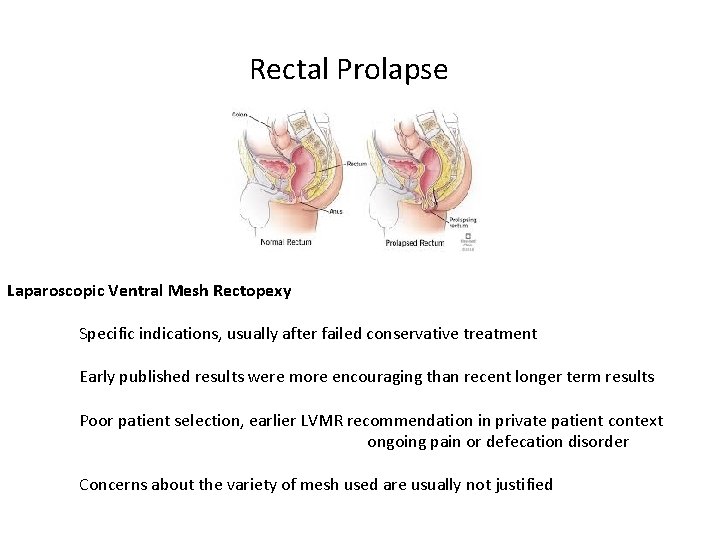 Rectal Prolapse Laparoscopic Ventral Mesh Rectopexy Specific indications, usually after failed conservative treatment Early Rectal Prolapse Laparoscopic Ventral Mesh Rectopexy Specific indications, usually after failed conservative treatment Early