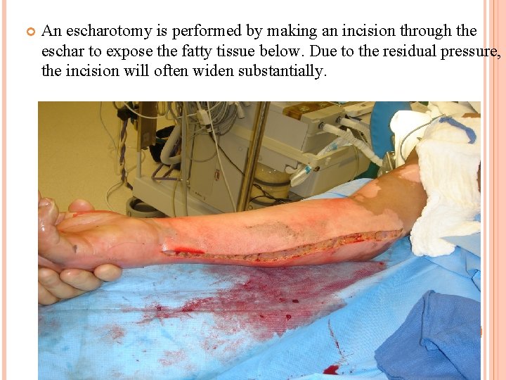 An escharotomy is performed by making an incision through the eschar to expose An escharotomy is performed by making an incision through the eschar to expose