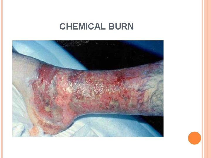 CHEMICAL BURN 5 CHEMICAL BURN 5