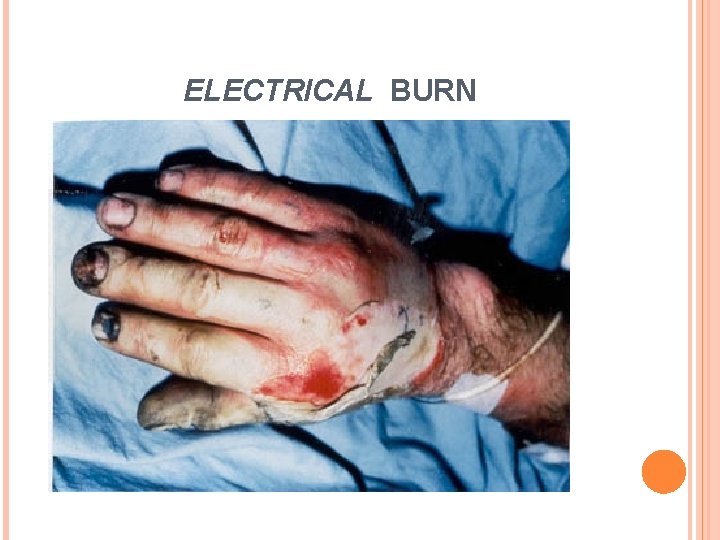 ELECTRICAL BURN 6 ELECTRICAL BURN 6