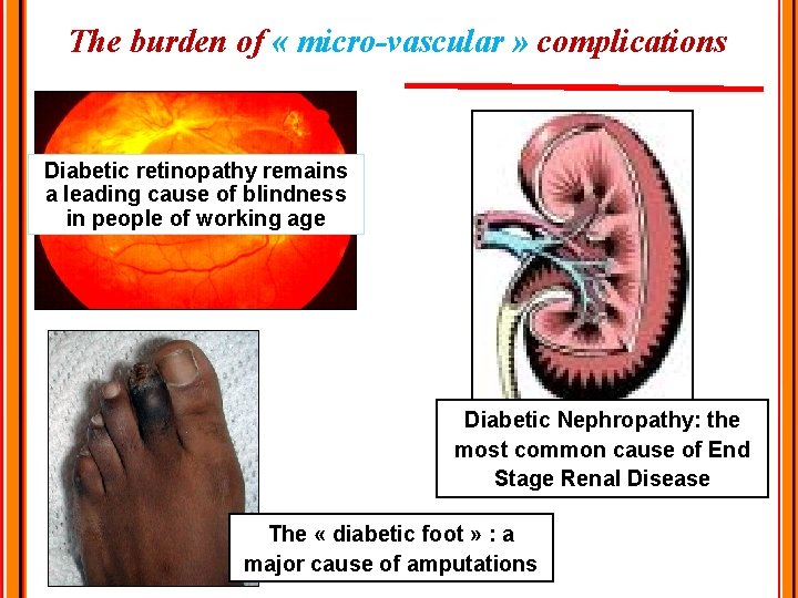 The burden of « micro-vascular » complications Diabetic retinopathy remains a leading cause of