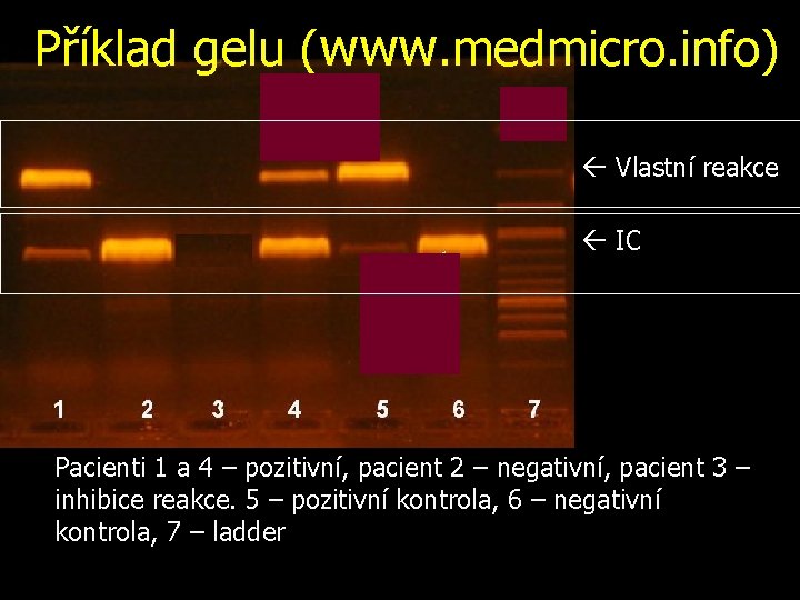 Příklad gelu (www. medmicro. info) Vlastní reakce IC Pacienti 1 a 4 – pozitivní,