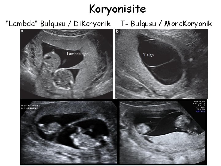 Koryonisite “Lambda“ Bulgusu / Di. Koryonik T- Bulgusu / Mono. Koryonik 