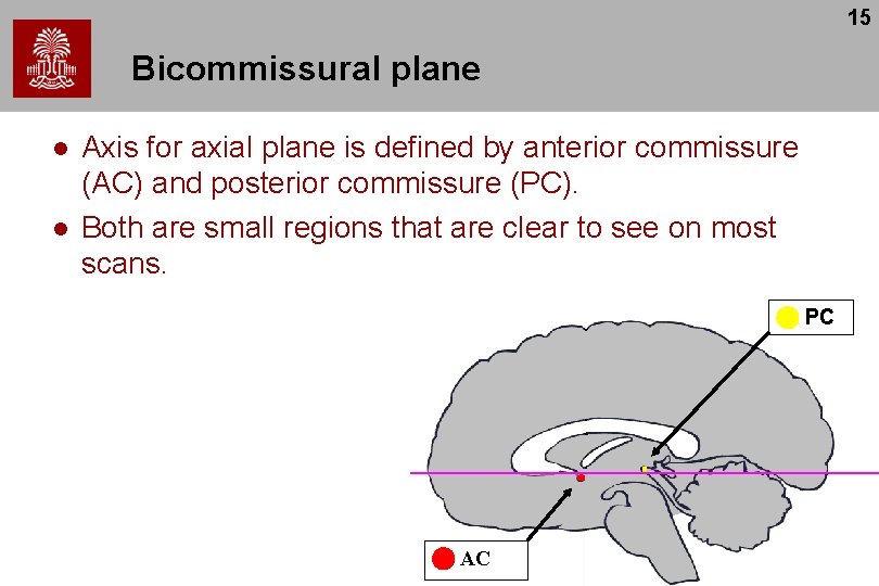 15 Bicommissural plane l l Axis for axial plane is defined by anterior commissure