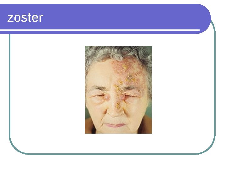 zoster 