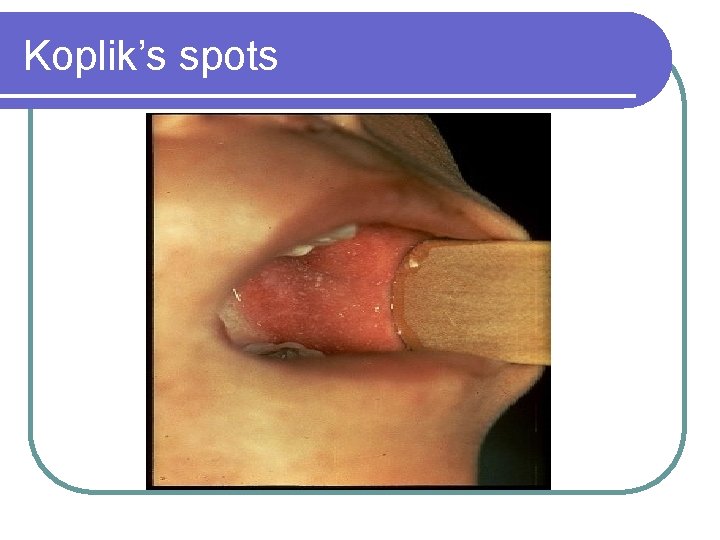 Koplik’s spots 