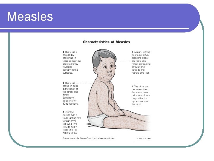 Measles 