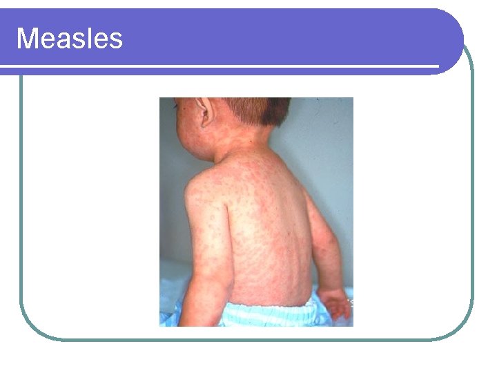 Measles 