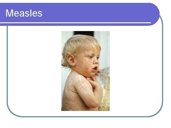 Measles 