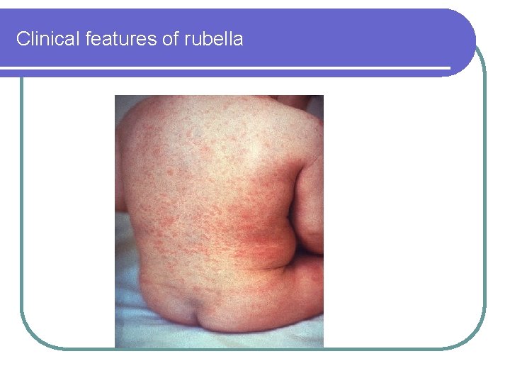 Clinical features of rubella 
