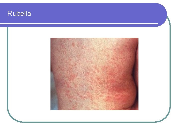 Rubella 