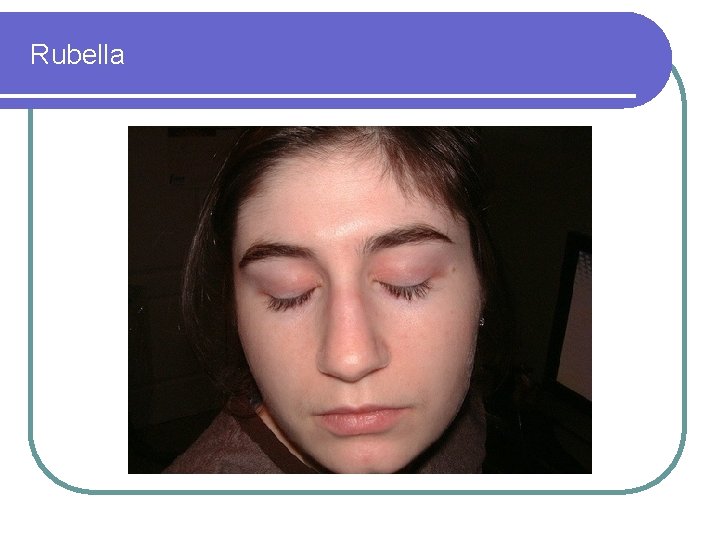 Rubella 