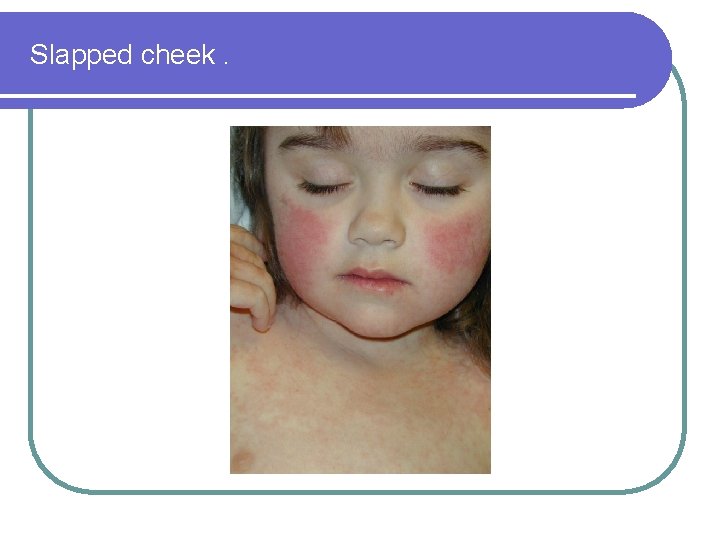 Slapped cheek. 