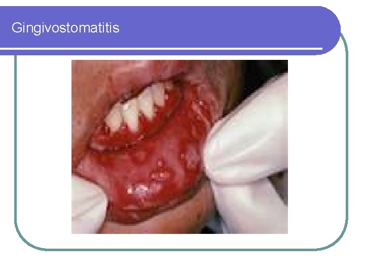 Gingivostomatitis 