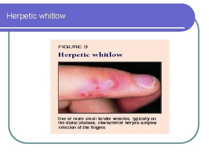 Herpetic whitlow 