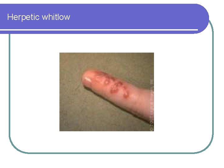 Herpetic whitlow 