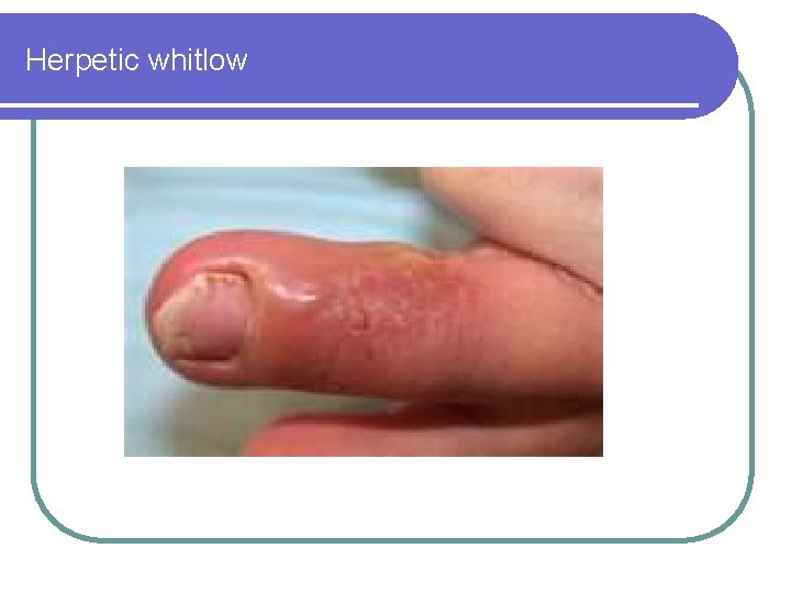 Herpetic whitlow 
