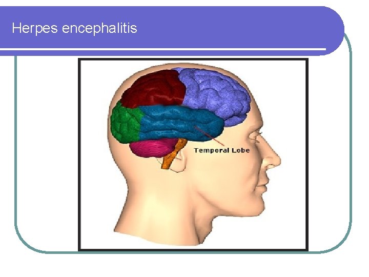 Herpes encephalitis 