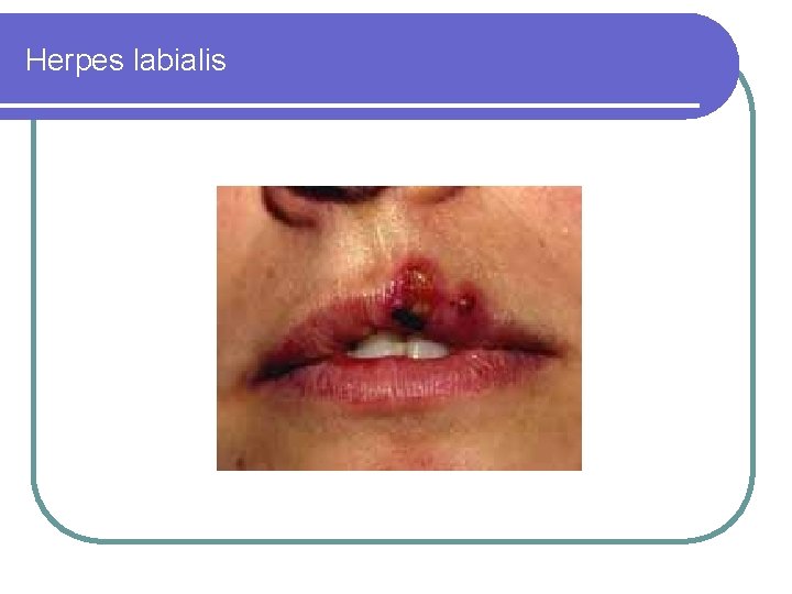 Herpes labialis 