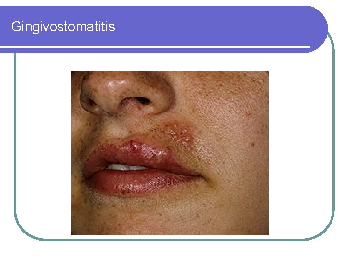 Gingivostomatitis 