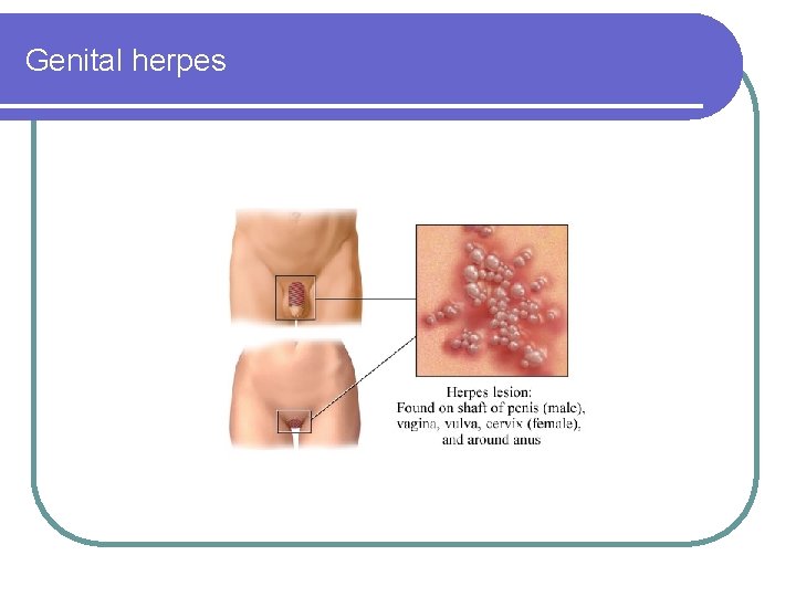 Genital herpes 