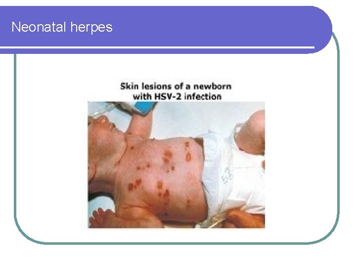 Neonatal herpes 