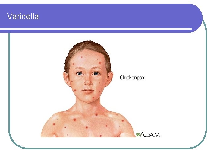 Varicella 