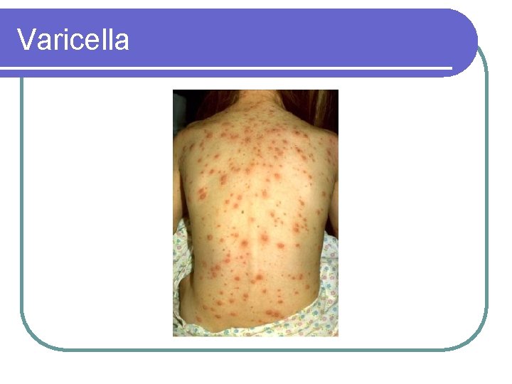 Varicella 