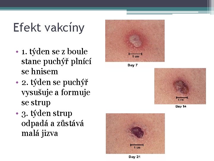 Efekt vakcíny • 1. týden se z boule stane puchýř plnící se hnisem •