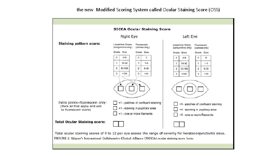 the new Modified Scoring System called Ocular Staining Score (OSS) the new Modified Scoring System called Ocular Staining Score (OSS)