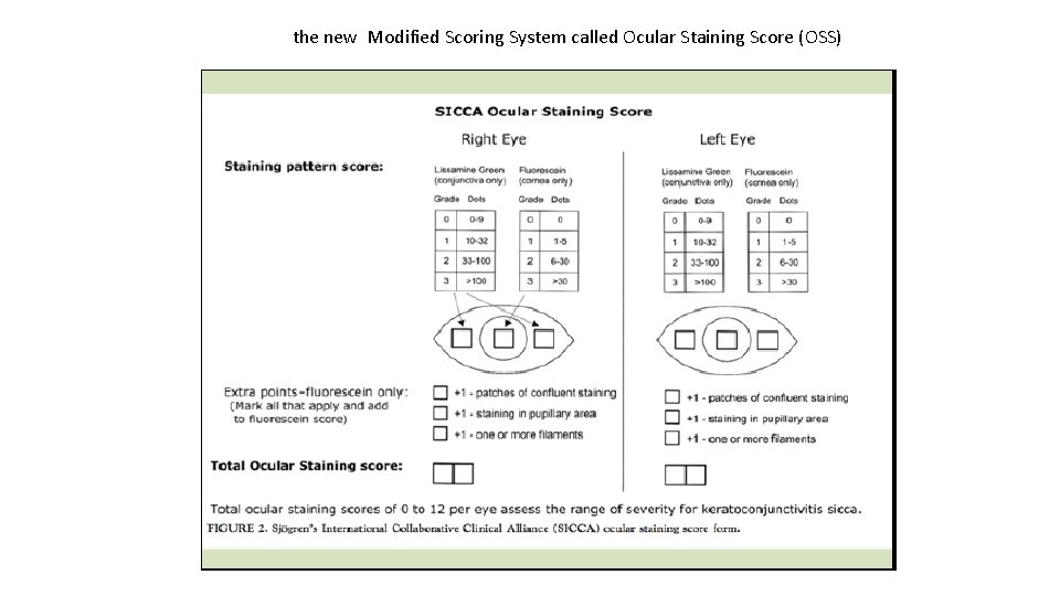 the new Modified Scoring System called Ocular Staining Score (OSS) 