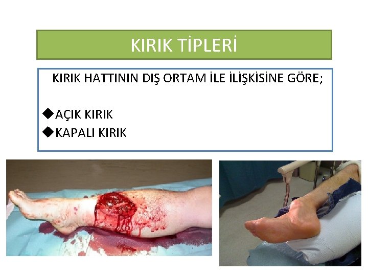 KIRIK TİPLERİ KIRIK HATTININ DIŞ ORTAM İLE İLİŞKİSİNE GÖRE; u. AÇIK KIRIK u. KAPALI