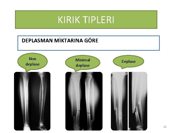 KIRIK TIPLERI DEPLASMAN MİKTARINA GÖRE Non deplase Minimal deplase Deplase 15 