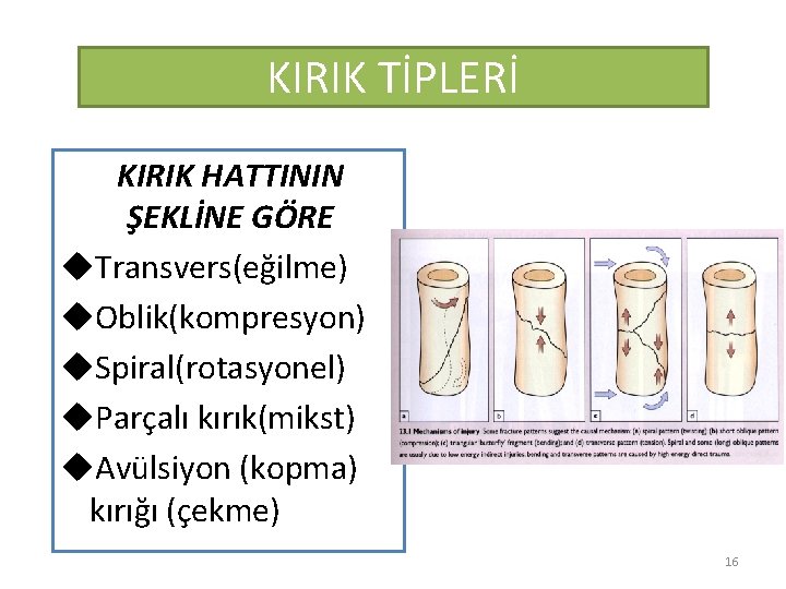 KIRIK TİPLERİ KIRIK HATTININ ŞEKLİNE GÖRE u. Transvers(eğilme) u. Oblik(kompresyon) u. Spiral(rotasyonel) u. Parçalı