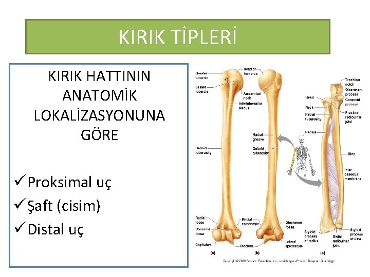 KIRIK TİPLERİ KIRIK HATTININ ANATOMİK LOKALİZASYONUNA GÖRE ü Proksimal uç ü Şaft (cisim) ü