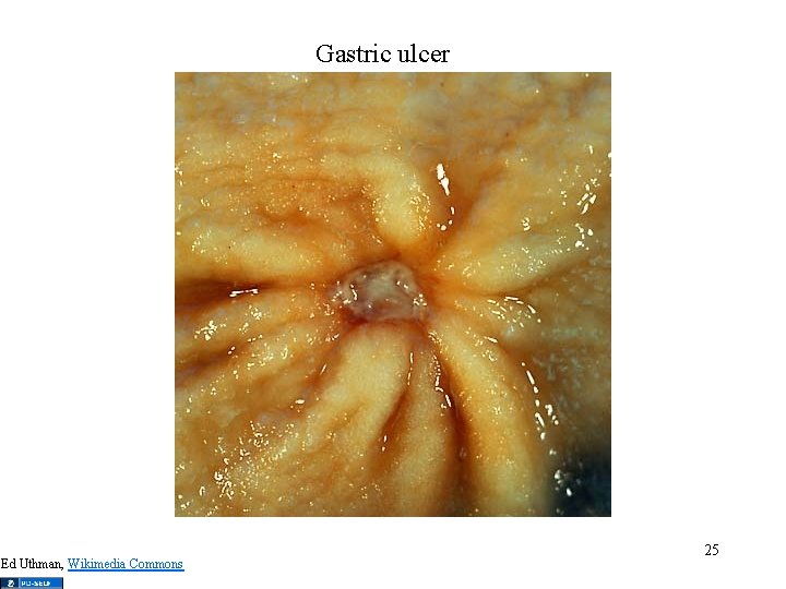Gastric ulcer Ed Uthman, Wikimedia Commons 25 