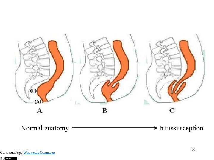Normal anatomy Commons. Tepi, Wikimedia Commons Intussusception 51 