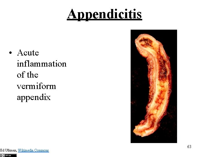 Appendicitis • Acute inflammation of the vermiform appendix Ed Uthman, Wikimedia Commons 63 