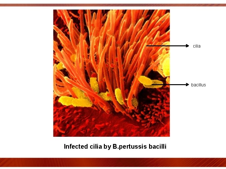 cilia bacillus Infected cilia by B. pertussis bacilli 