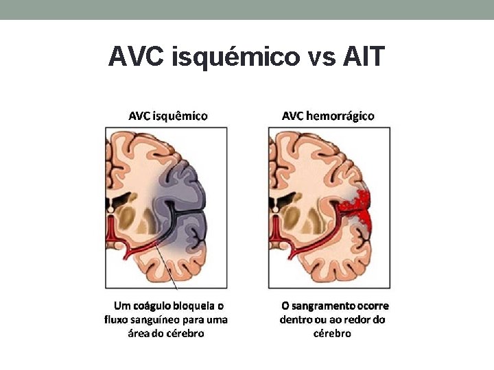 AVC isquémico vs AIT 