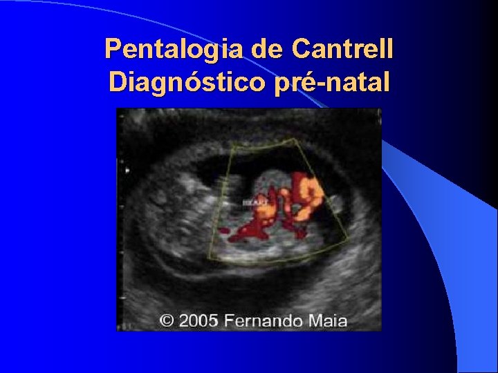 Pentalogia de Cantrell Diagnóstico pré-natal 