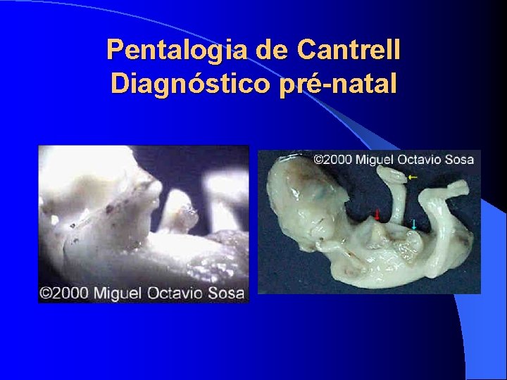 Pentalogia de Cantrell Diagnóstico pré-natal 