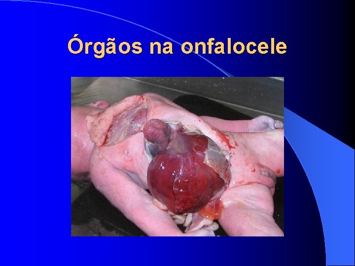 Órgãos na onfalocele 