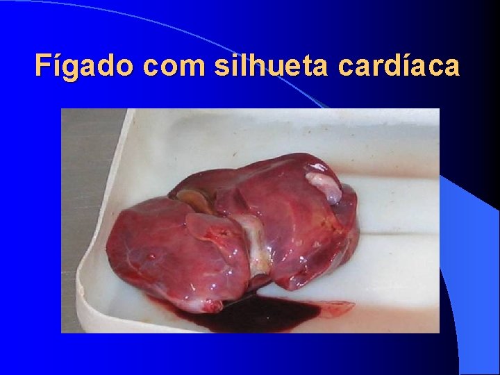 Fígado com silhueta cardíaca 